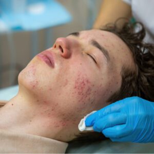 Problem-Prone Skin (Acne)