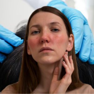 Rosacea Facial